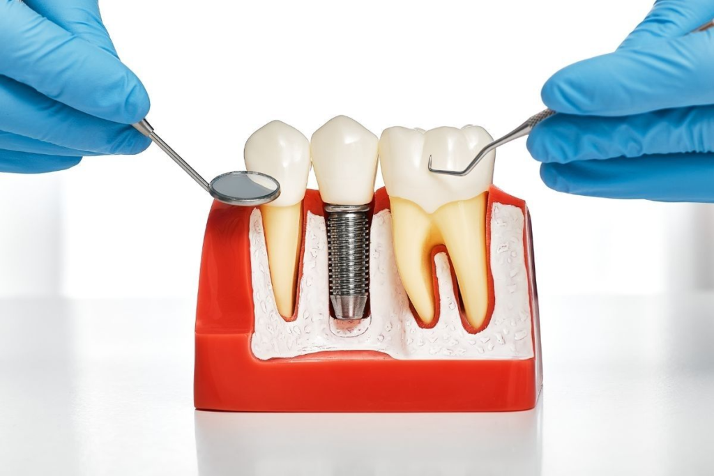 dental implants near me
